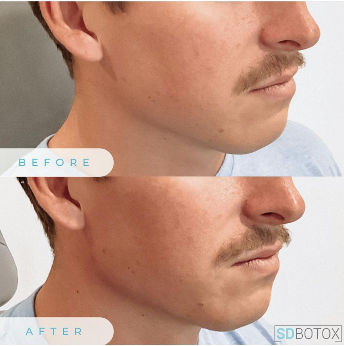 Jawline Filler Before & After Gallery - Patient 187061846 - Image 1