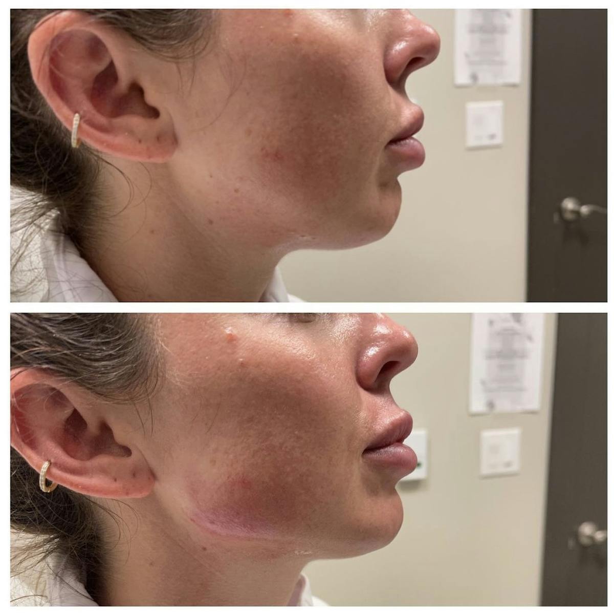 Jawline Filler Before & After Gallery - Patient 187061847 - Image 1