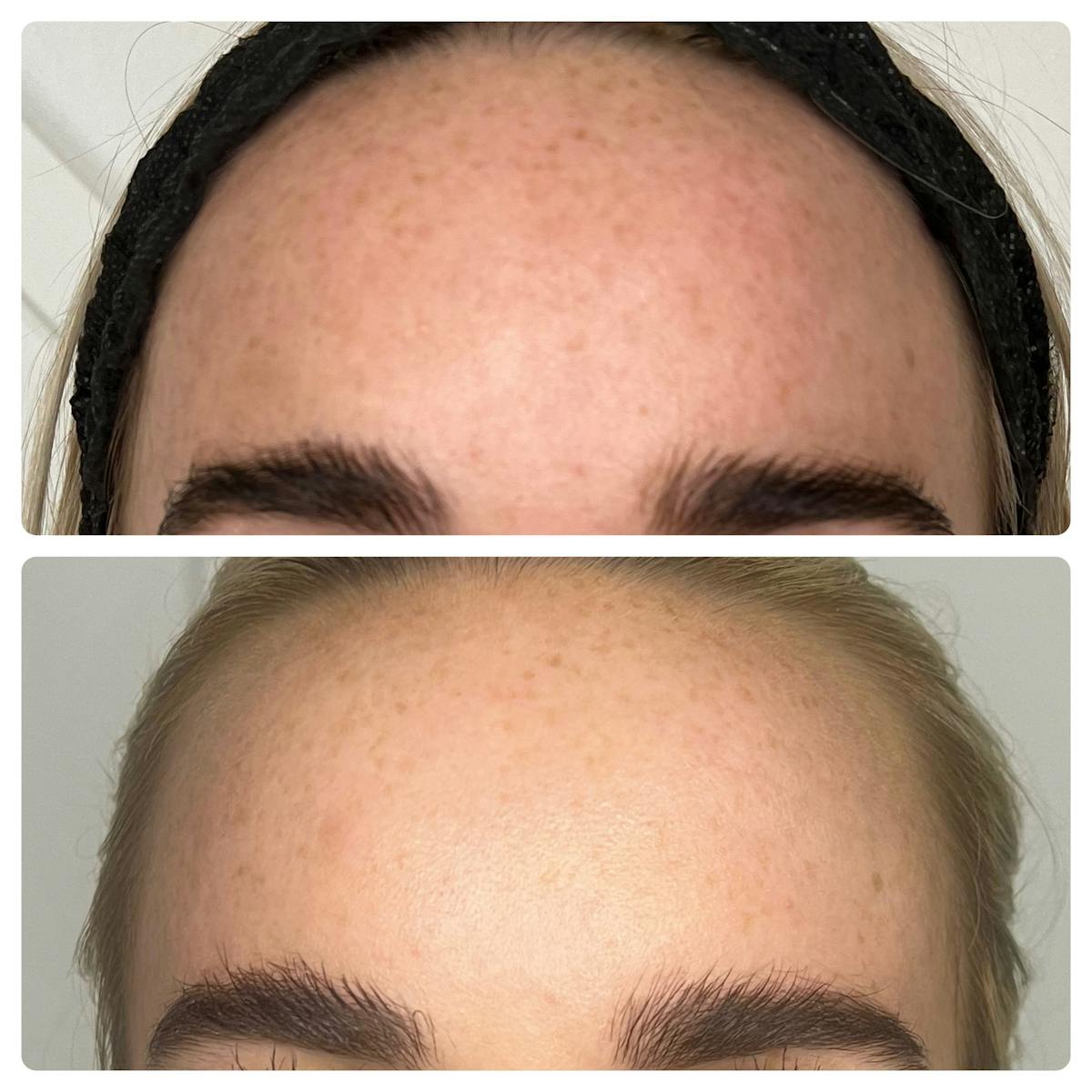 Chemical Peel Before & After Gallery - Patient 187062272 - Image 3