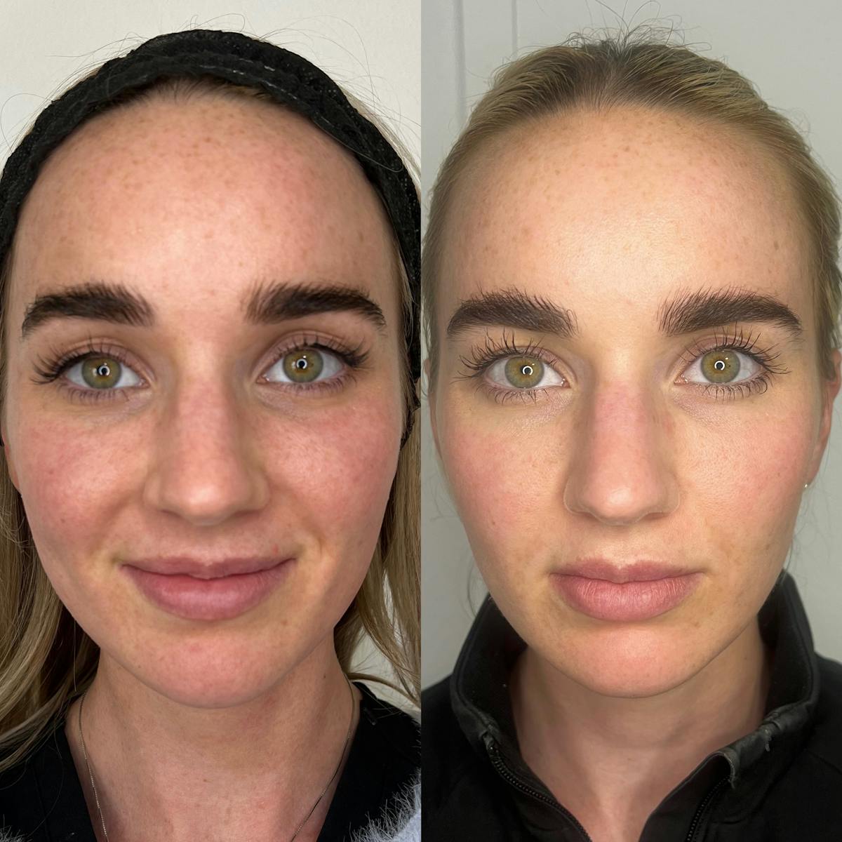Chemical Peel Before & After Gallery - Patient 187062272 - Image 1