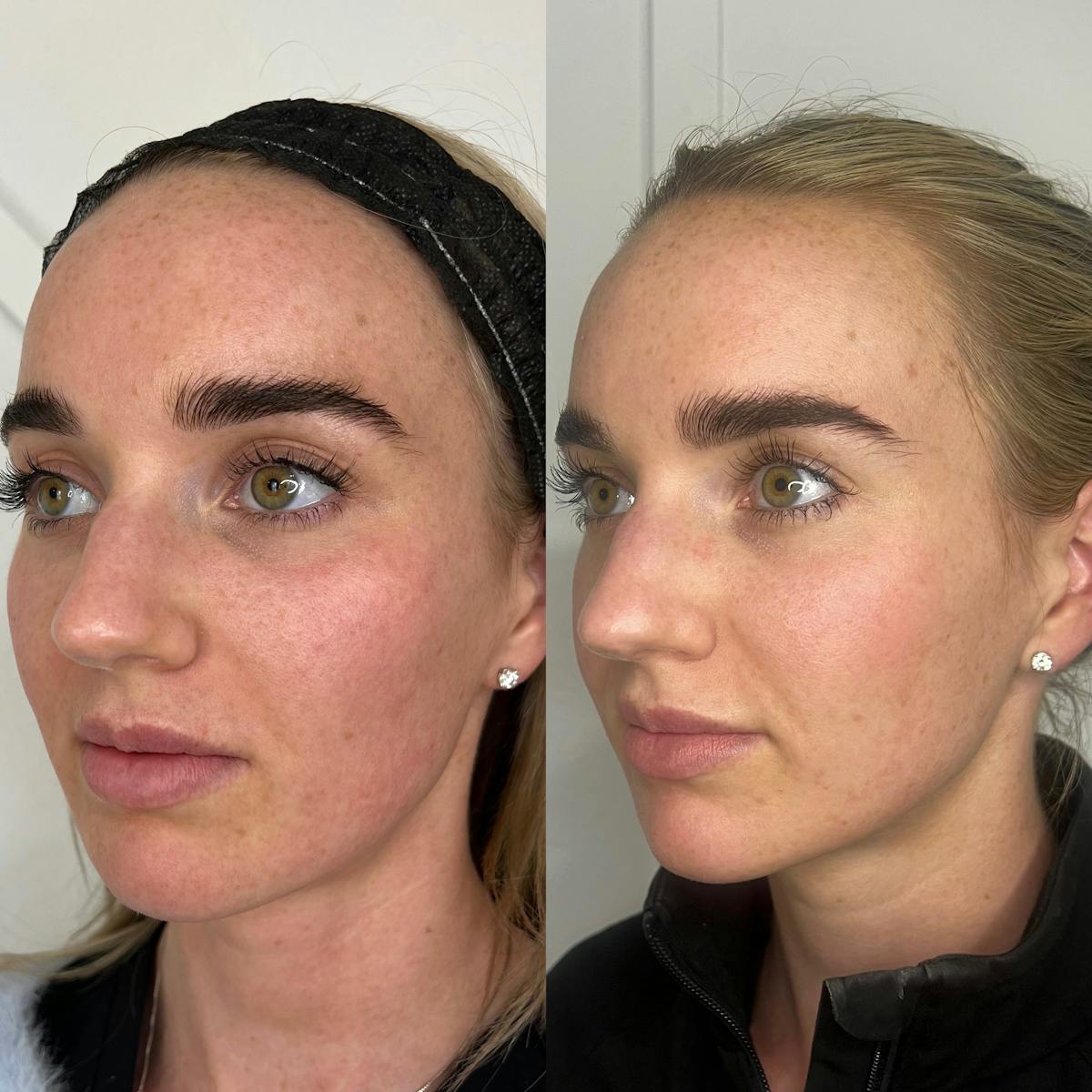Chemical Peel Before & After Gallery - Patient 187062272 - Image 2
