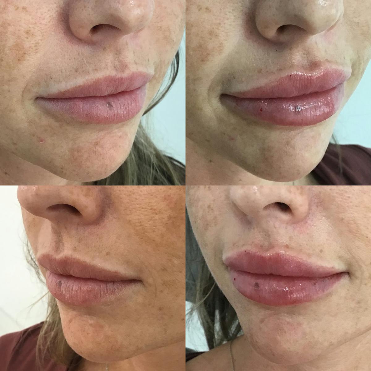 Lip Filler Before & After Gallery - Patient 187063353 - Image 1