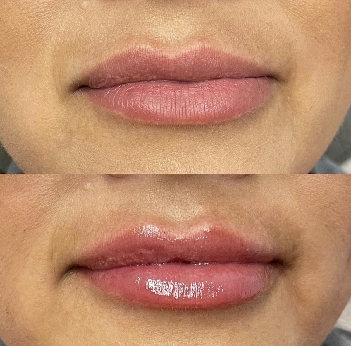 Lip Filler Before & After Gallery - Patient 187063355 - Image 1