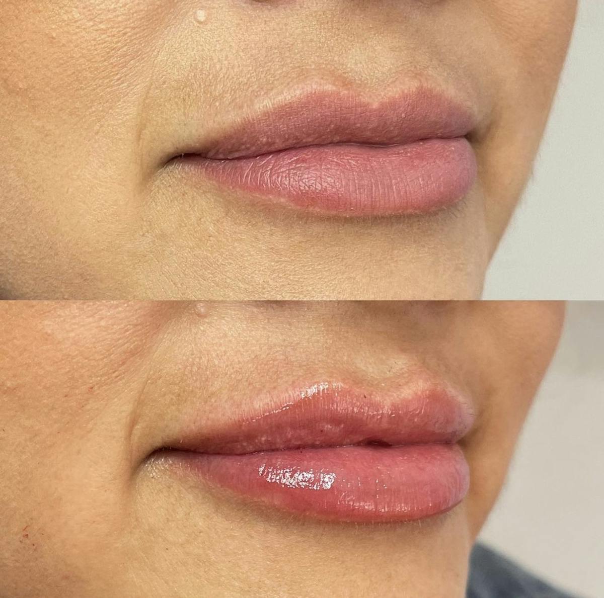 Lip Filler Before & After Gallery - Patient 187063355 - Image 2
