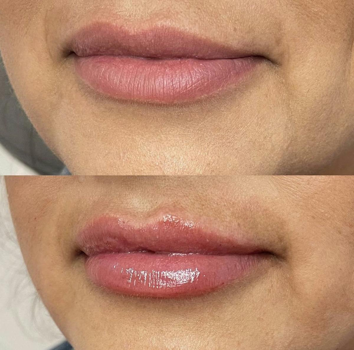 Lip Filler Before & After Gallery - Patient 187063355 - Image 3