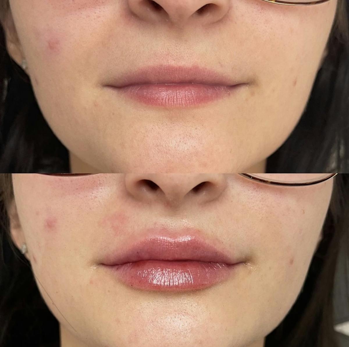 Lip Filler Before & After Gallery - Patient 187063356 - Image 1