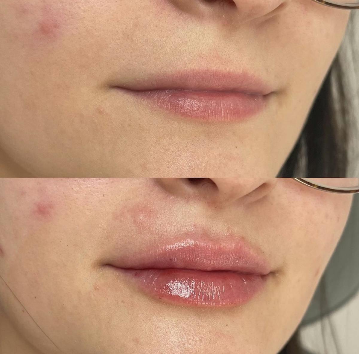 Lip Filler Before & After Gallery - Patient 187063356 - Image 2