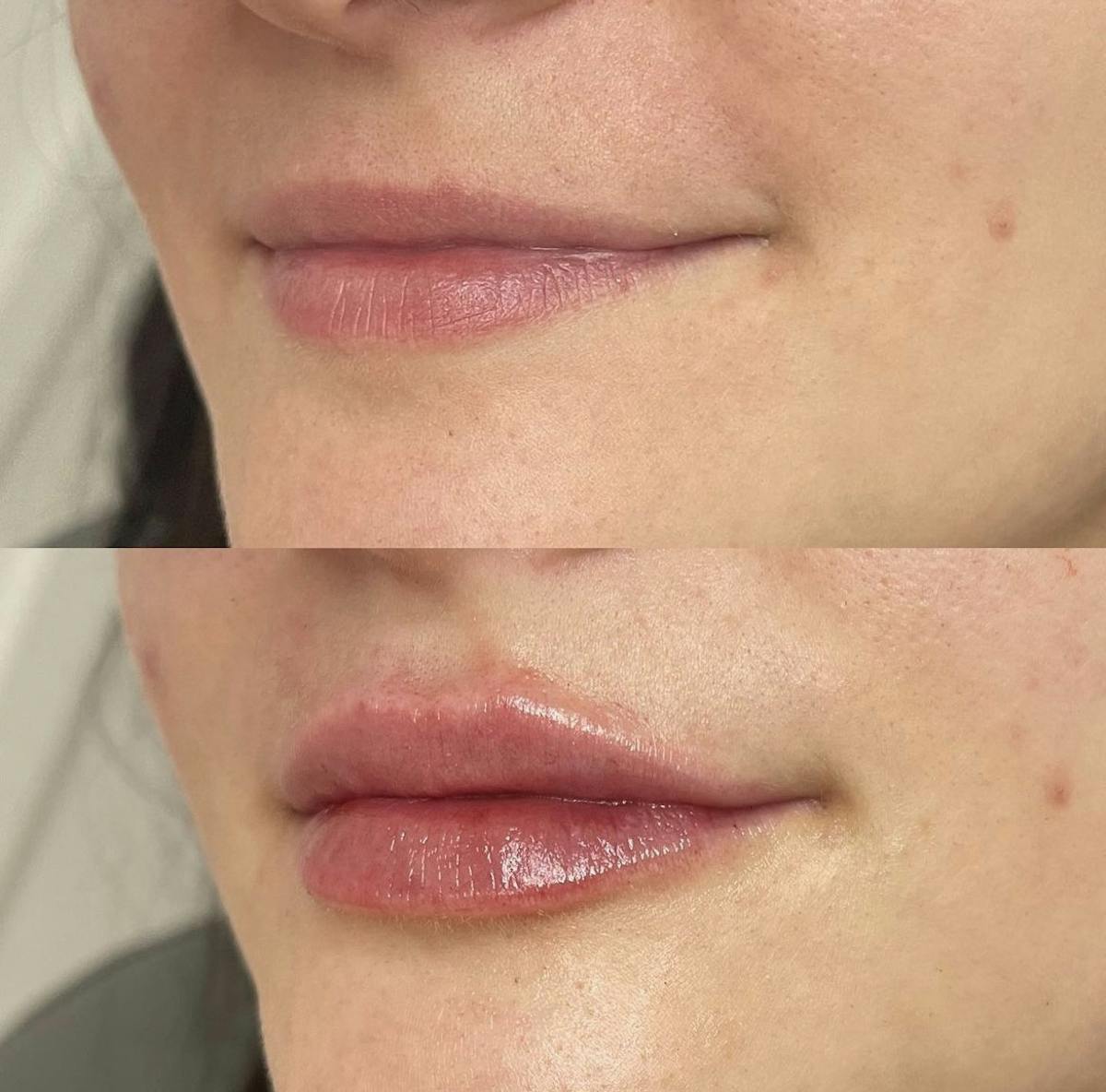 Lip Filler Before & After Gallery - Patient 187063356 - Image 3