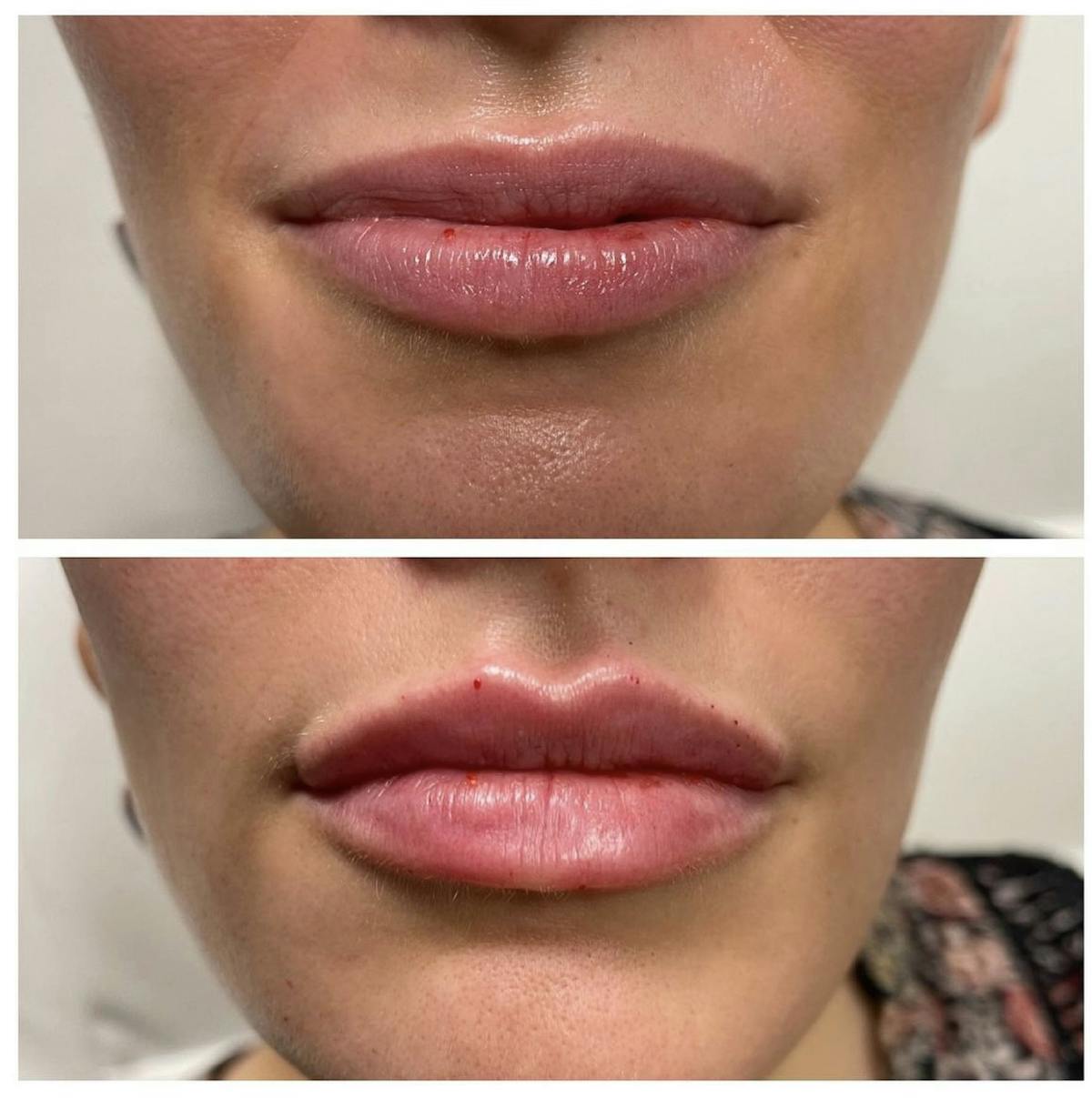 Lip Filler Before & After Gallery - Patient 187063357 - Image 1