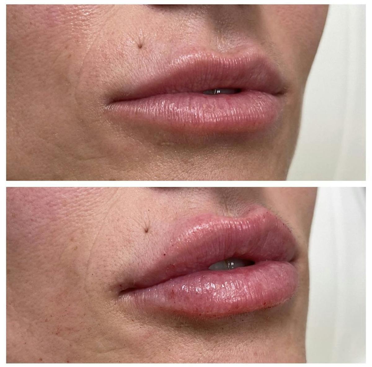Lip Filler Before & After Gallery - Patient 187063358 - Image 1