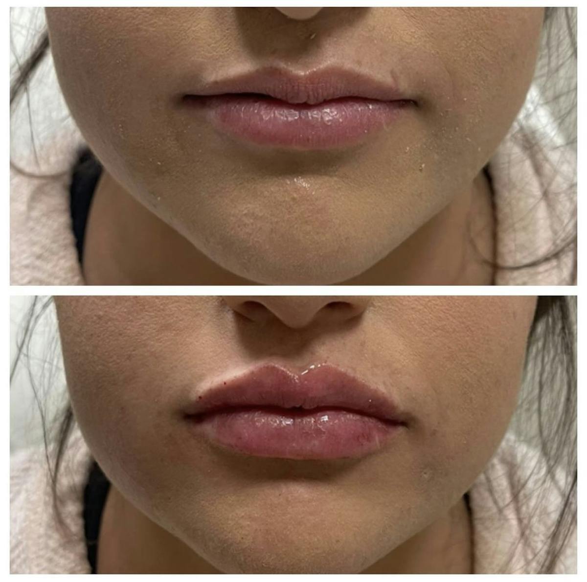 Lip Filler Before & After Gallery - Patient 187063359 - Image 1