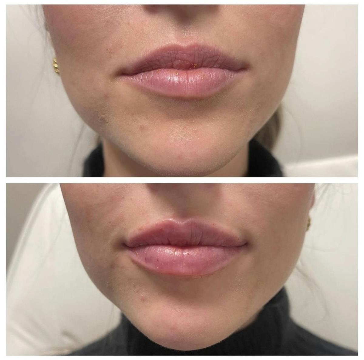 Lip Filler Before & After Gallery - Patient 187063360 - Image 1