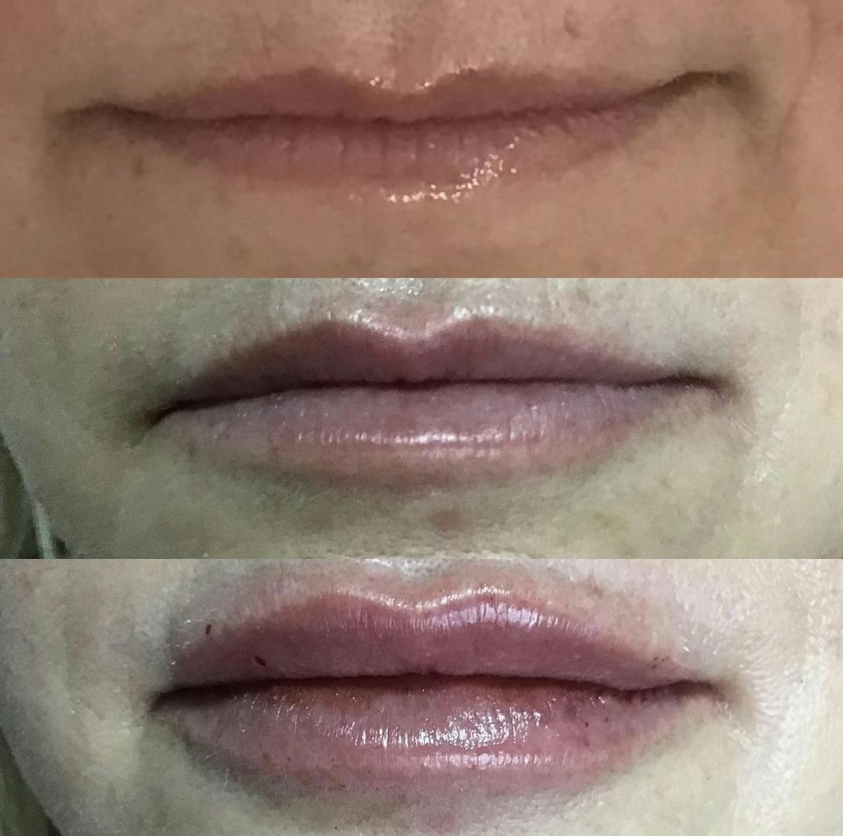 Lip Filler Before & After Gallery - Patient 187063361 - Image 1