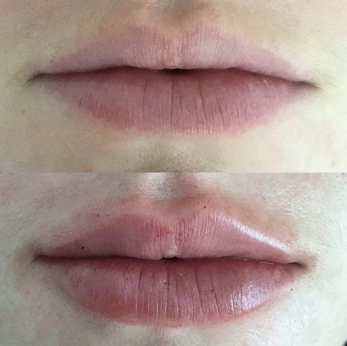 Lip Filler Before & After Gallery - Patient 187063362 - Image 1