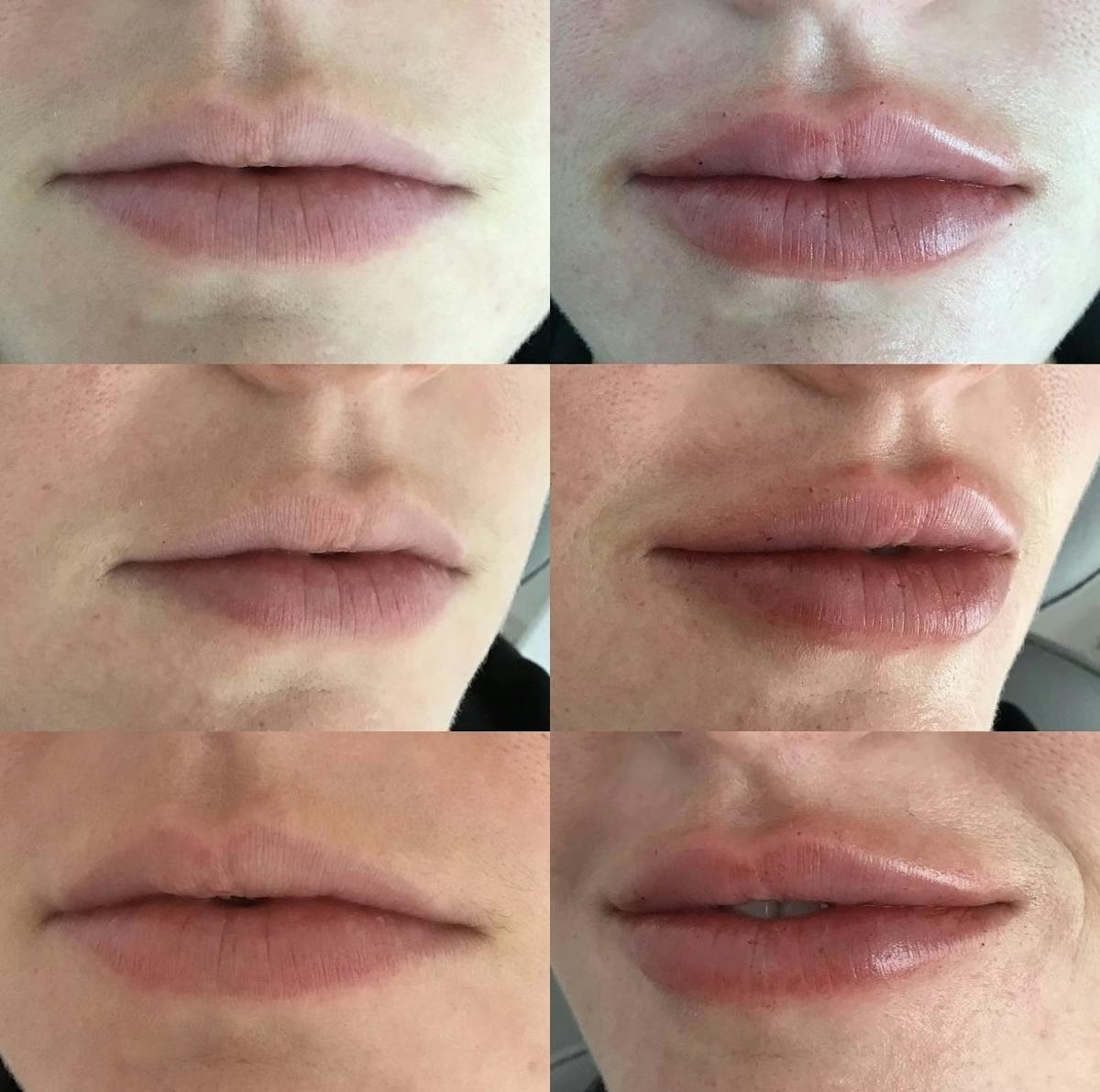 Lip Filler Before & After Gallery - Patient 187063363 - Image 1