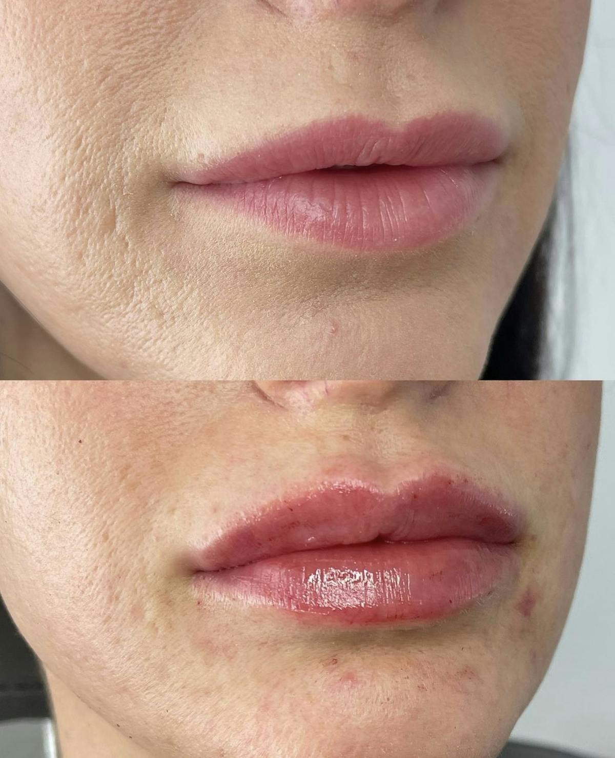 Lip Filler Before & After Gallery - Patient 187063364 - Image 1