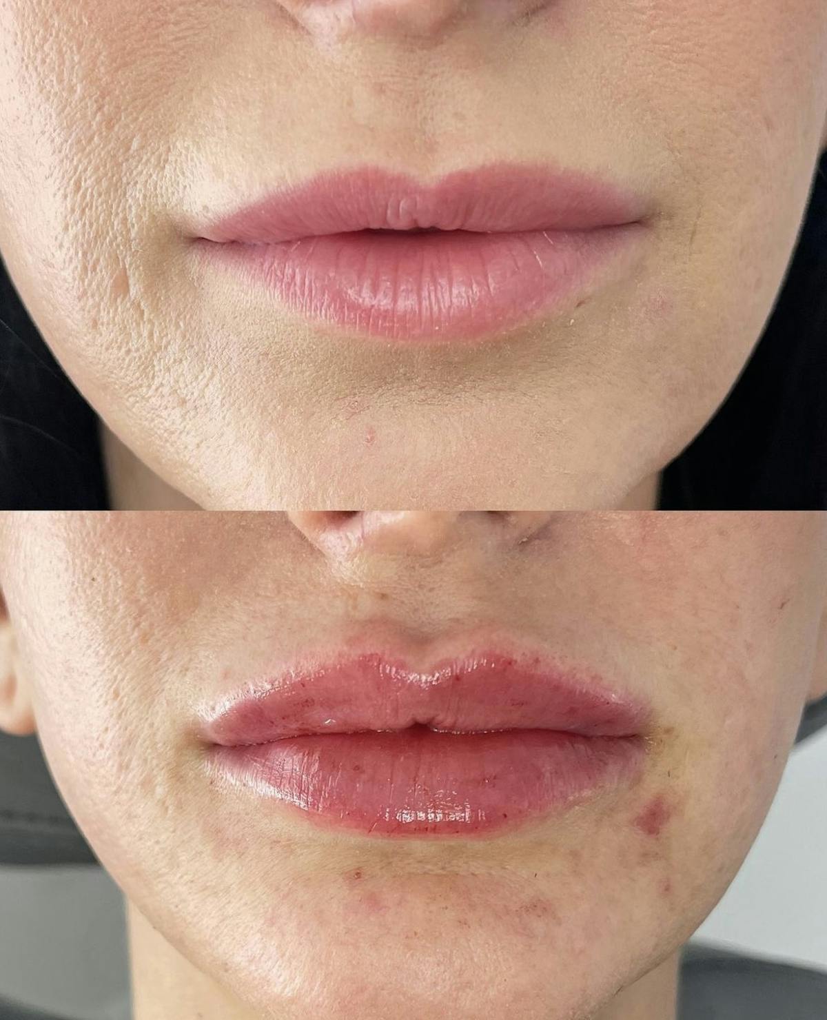 Lip Filler Before & After Gallery - Patient 187063364 - Image 2