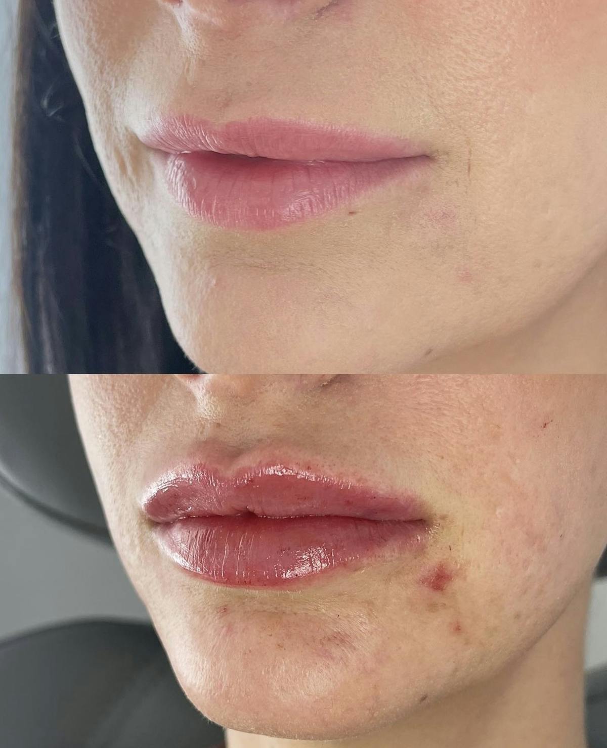 Lip Filler Before & After Gallery - Patient 187063364 - Image 3