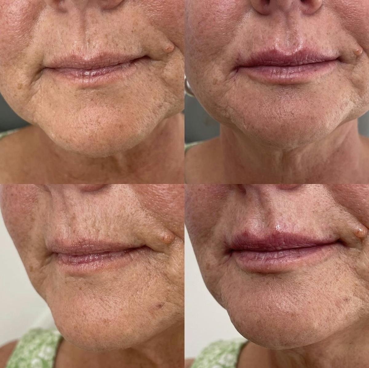 Lip Filler Before & After Gallery - Patient 187063676 - Image 1