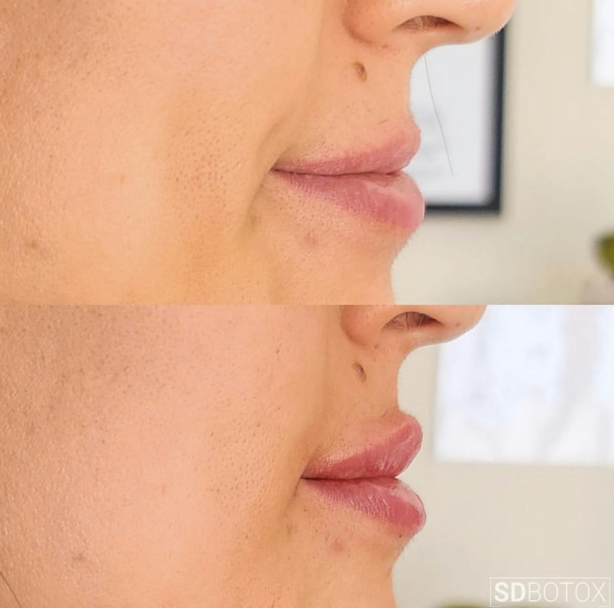 Lip Filler Before & After Gallery - Patient 187063677 - Image 1