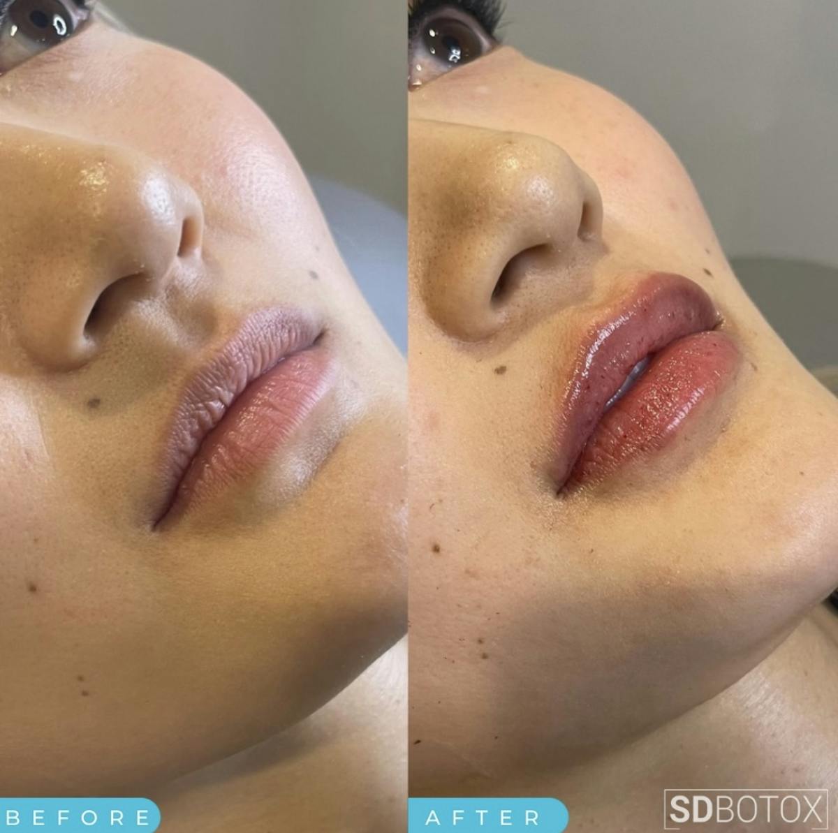 Lip Filler Before & After Gallery - Patient 187063678 - Image 1