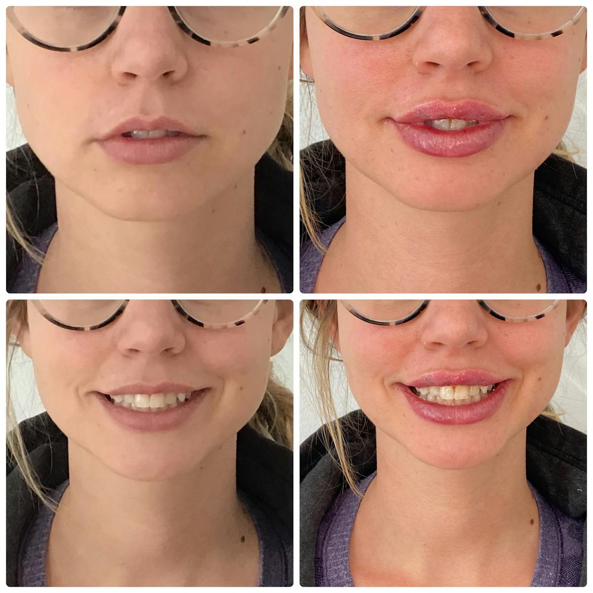 Lip Filler Before & After Gallery - Patient 187063679 - Image 1
