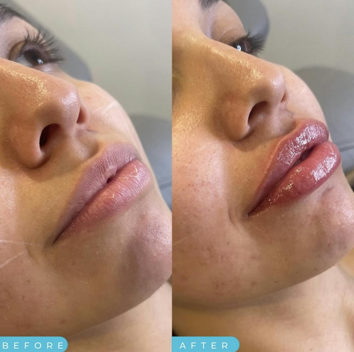 Lip Filler Before & After Gallery - Patient 187063680 - Image 1
