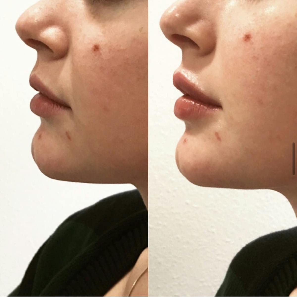 Lip Filler Before & After Gallery - Patient 187063681 - Image 1