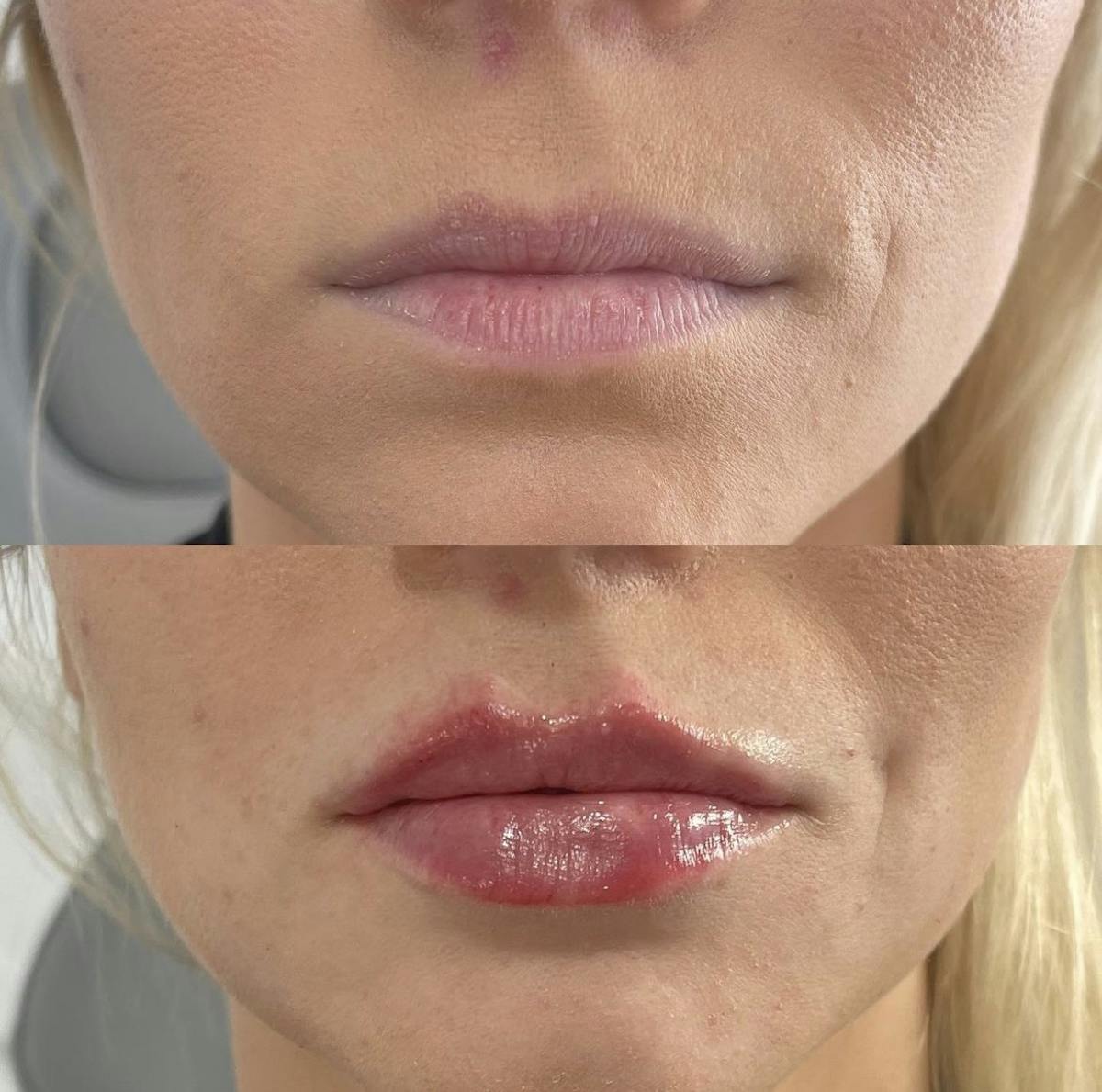 Lip Filler Before & After Gallery - Patient 187063682 - Image 1