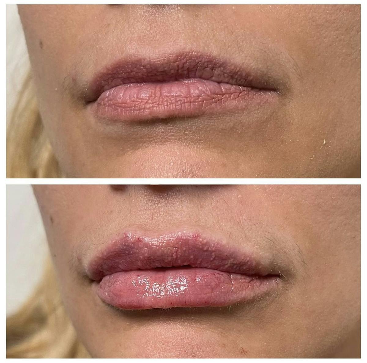 Lip Filler Before & After Gallery - Patient 187063684 - Image 1