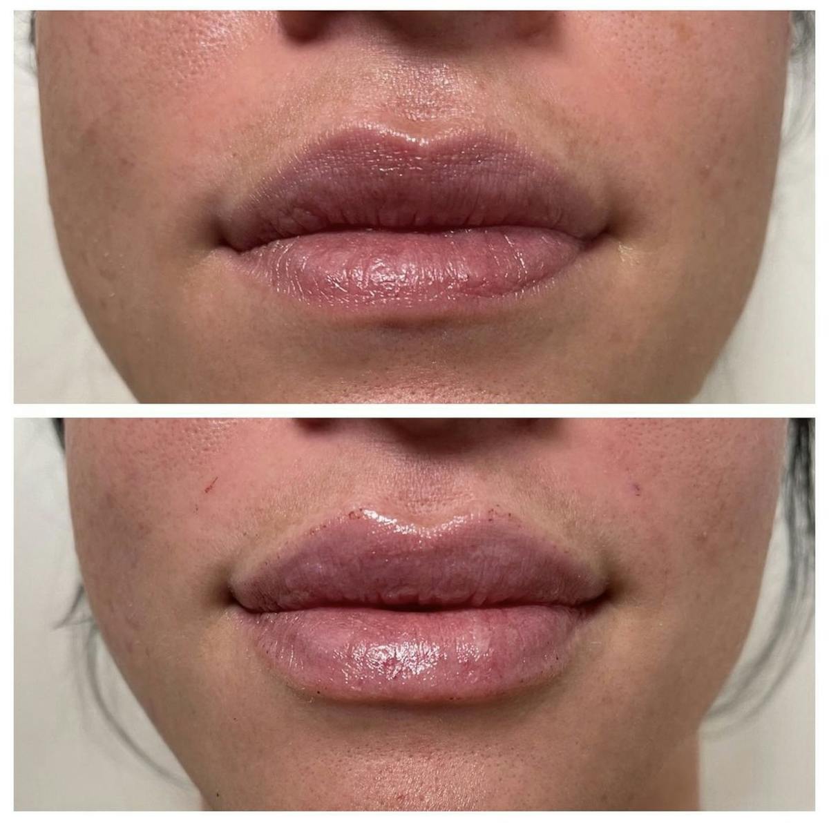 Lip Filler Before & After Gallery - Patient 187063685 - Image 1