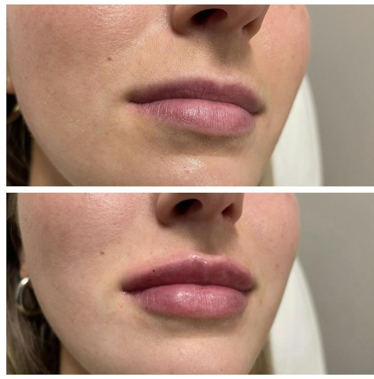 Lip Filler Before & After Gallery - Patient 187063686 - Image 1