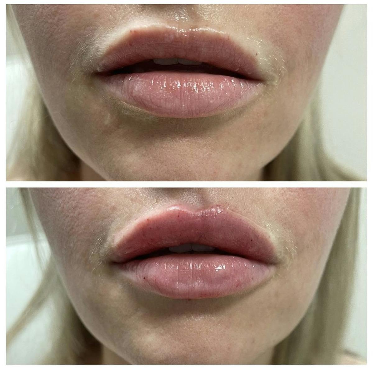 Lip Filler Before & After Gallery - Patient 187064160 - Image 1