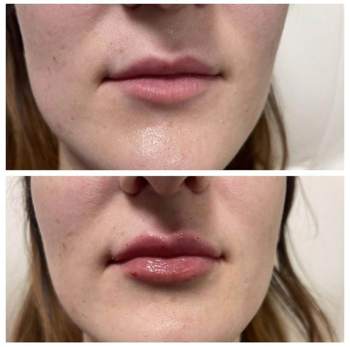 Lip Filler Before & After Gallery - Patient 187073925 - Image 1