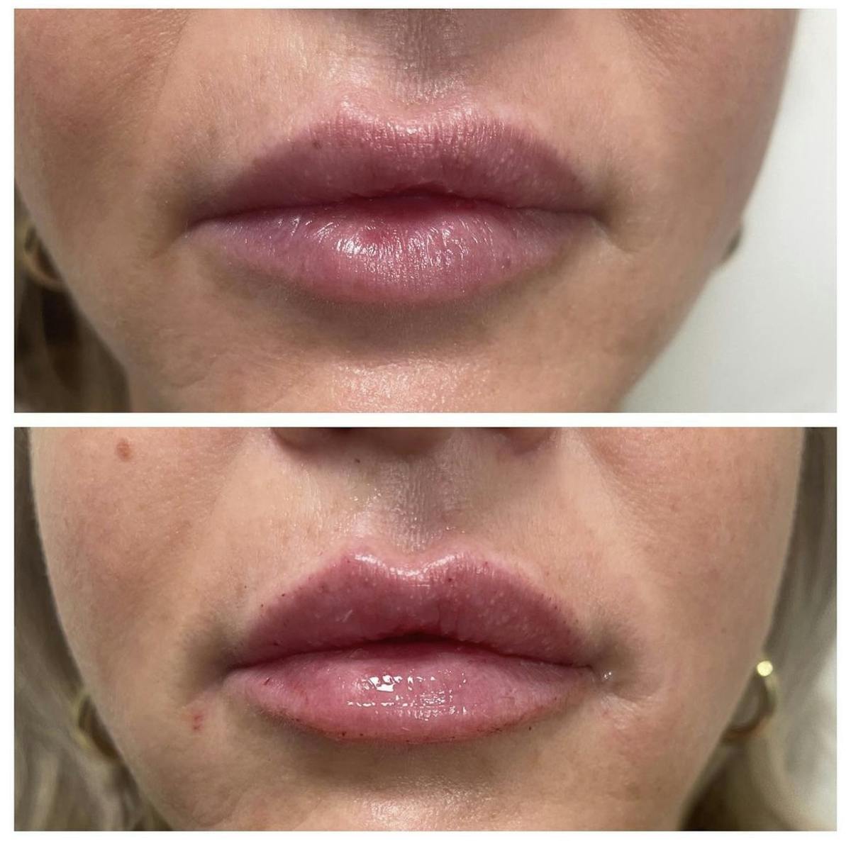 Lip Filler Before & After Gallery - Patient 187073926 - Image 1