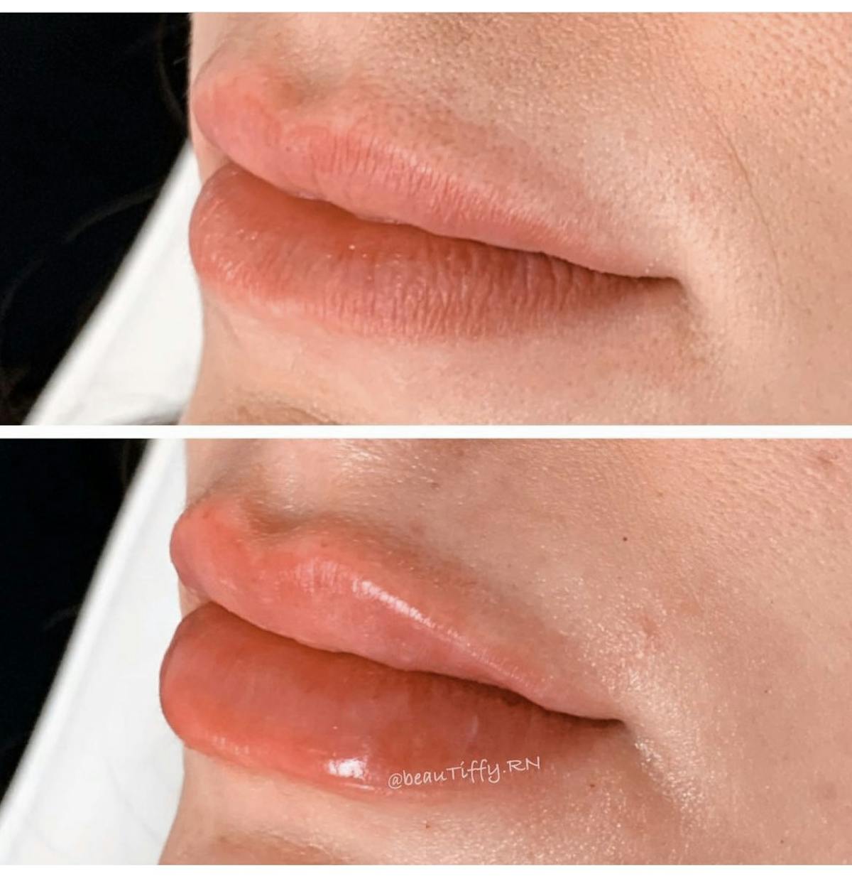 Lip Filler Before & After Gallery - Patient 187073927 - Image 1