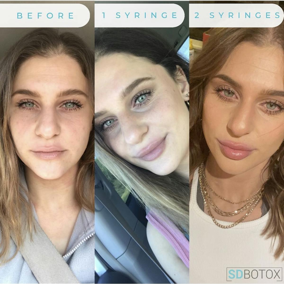 Lip Filler Before & After Gallery - Patient 187073928 - Image 1