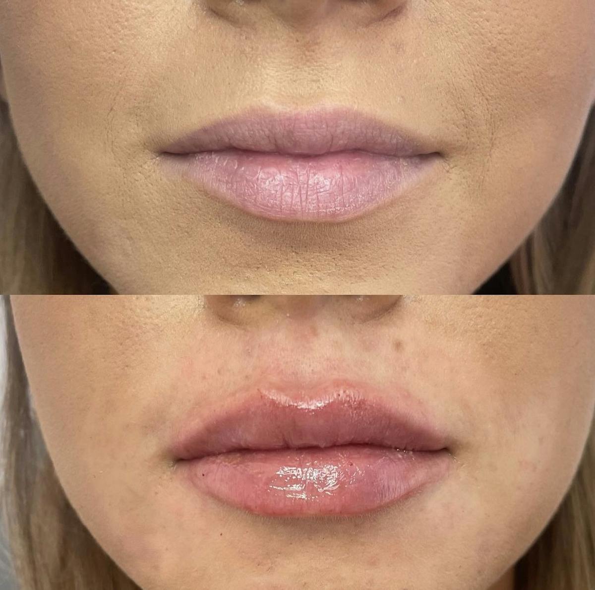 Lip Filler Before & After Gallery - Patient 187073929 - Image 1