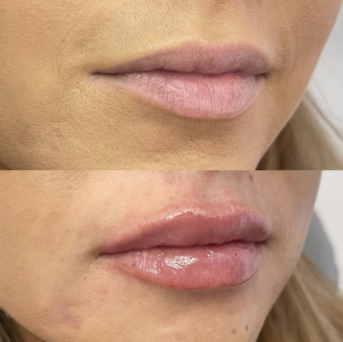 Lip Filler Before & After Gallery - Patient 187073929 - Image 2