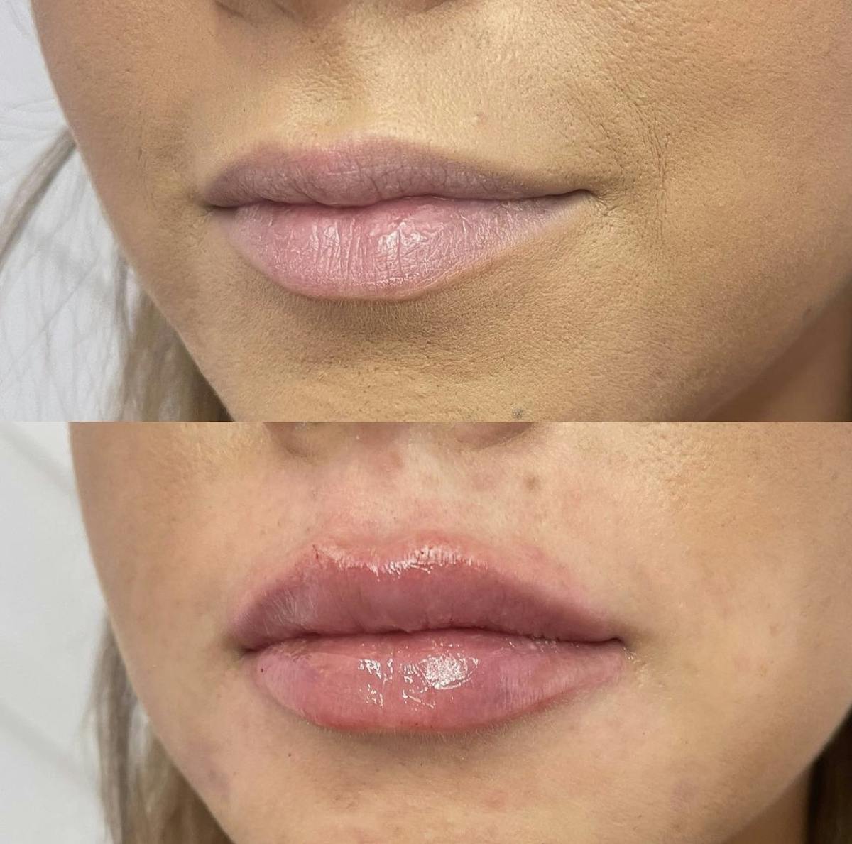 Lip Filler Before & After Gallery - Patient 187073929 - Image 3