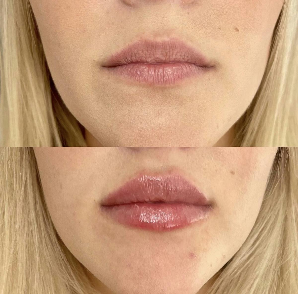 Lip Filler Before & After Gallery - Patient 187073930 - Image 1