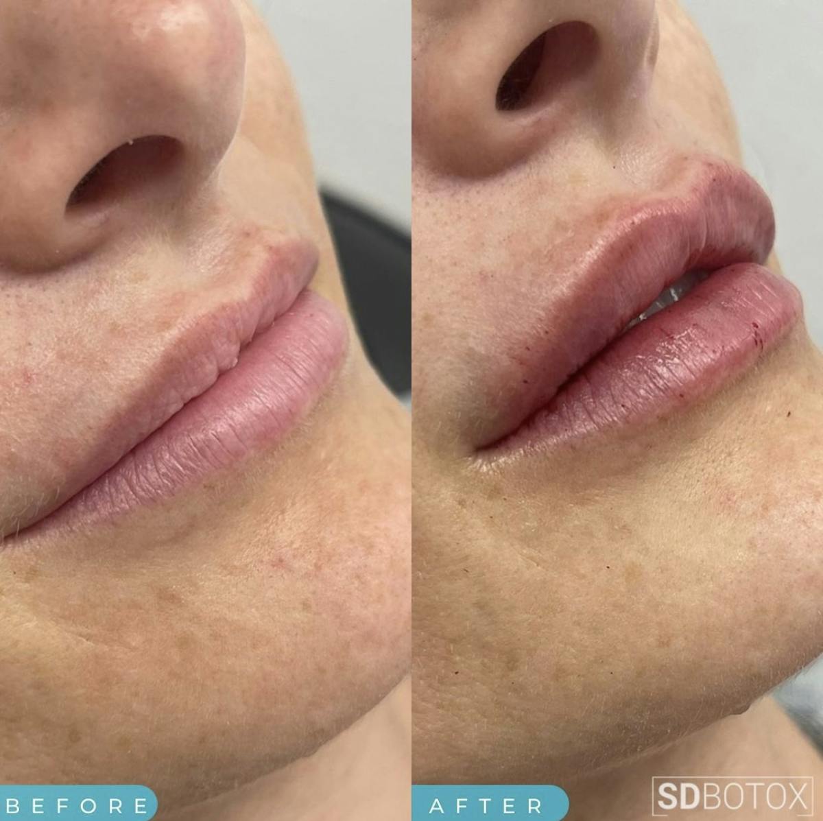 Lip Filler Before & After Gallery - Patient 187073931 - Image 1