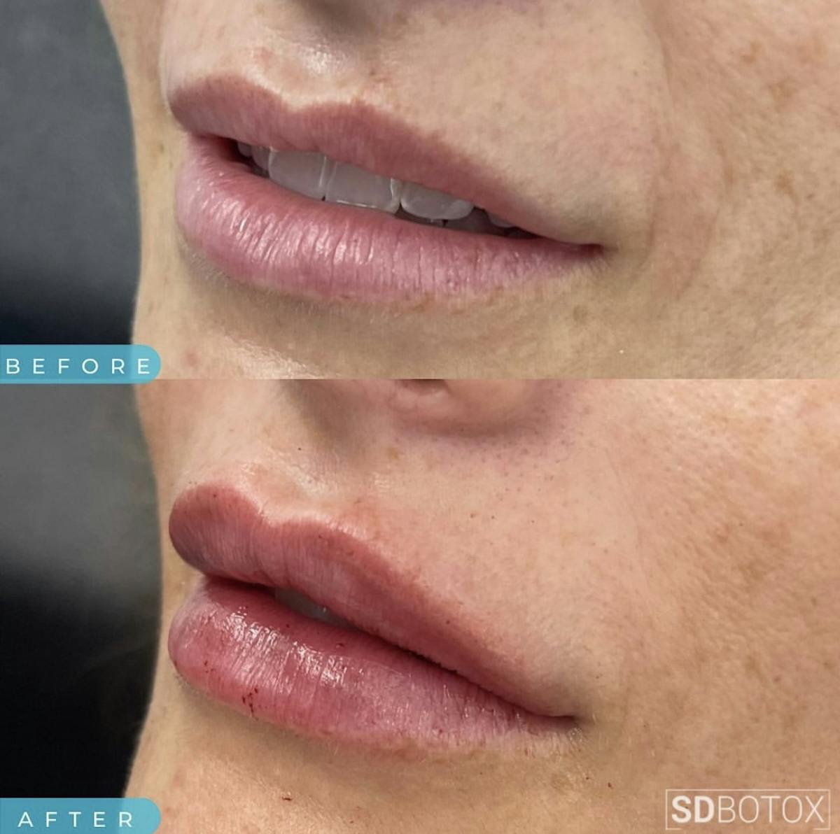 Lip Filler Before & After Gallery - Patient 187073931 - Image 2