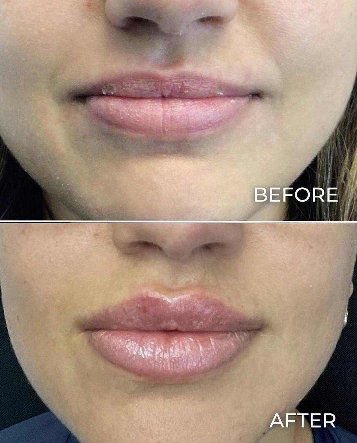 Lip Filler Before & After Gallery - Patient 187073933 - Image 1