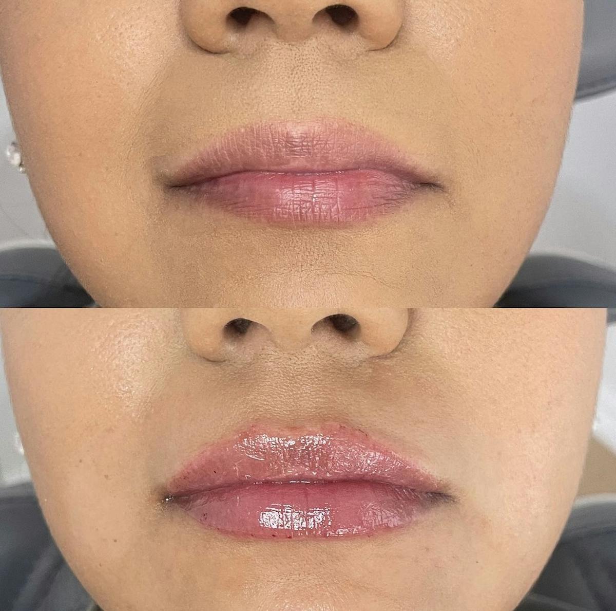 Lip Filler Before & After Gallery - Patient 187073934 - Image 1