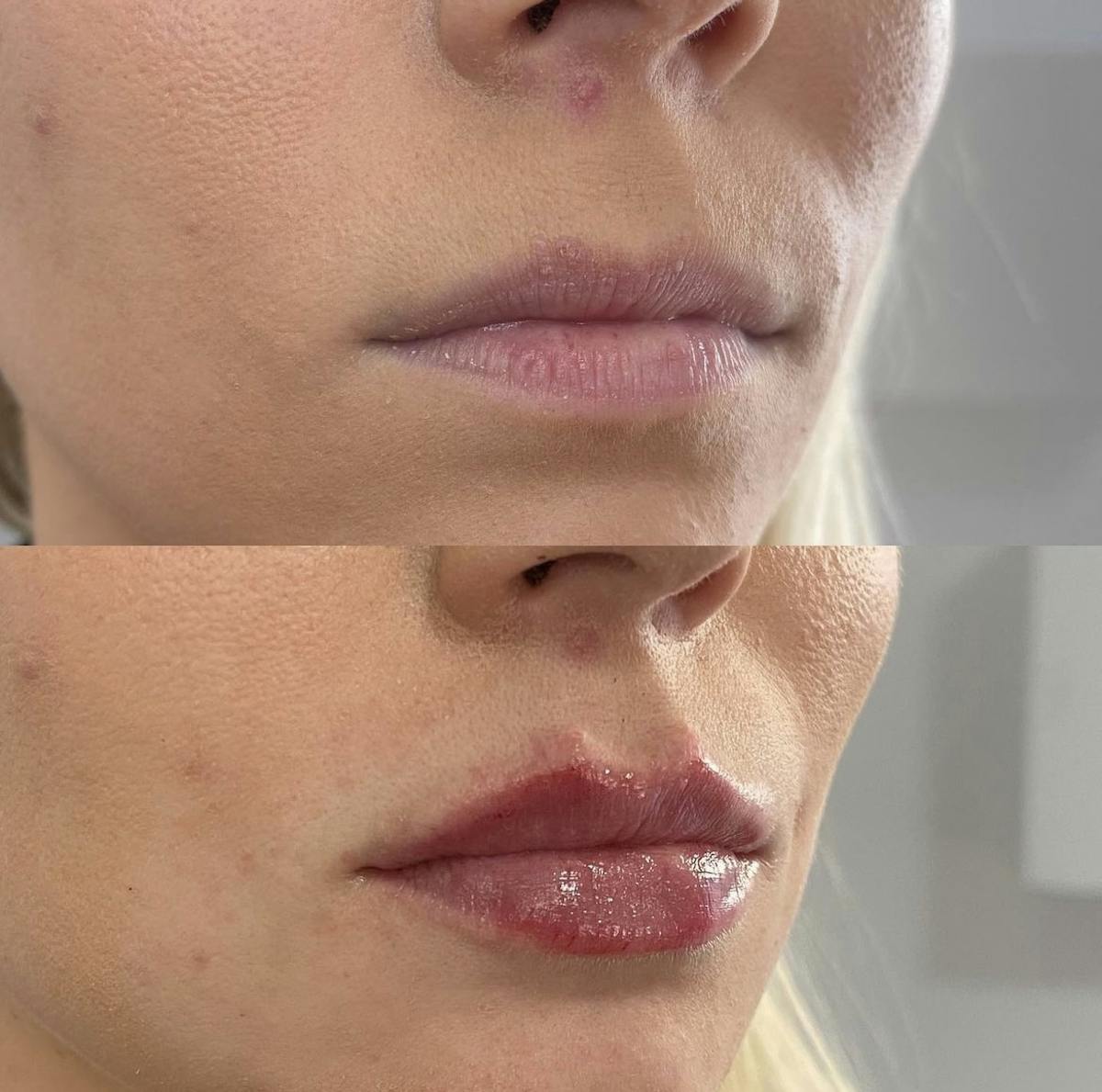 Lip Filler Before & After Gallery - Patient 187073935 - Image 1