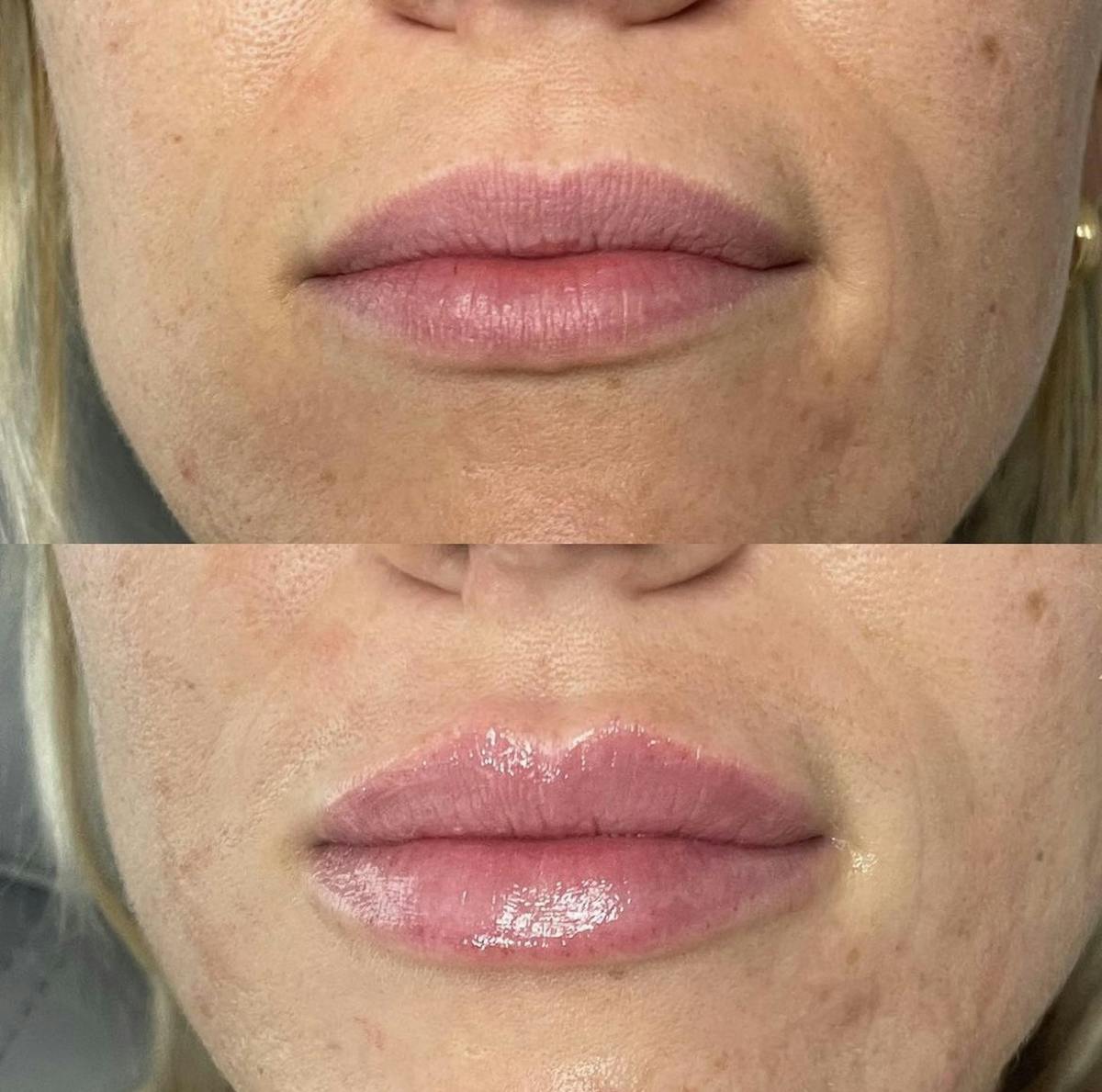 Lip Filler Before & After Gallery - Patient 187073937 - Image 1