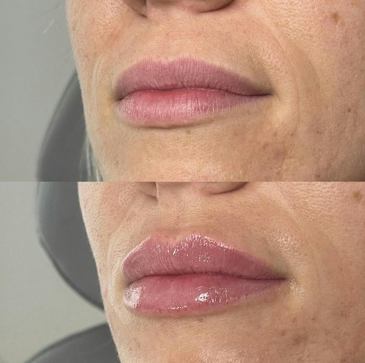 Lip Filler Before & After Gallery - Patient 187073937 - Image 2
