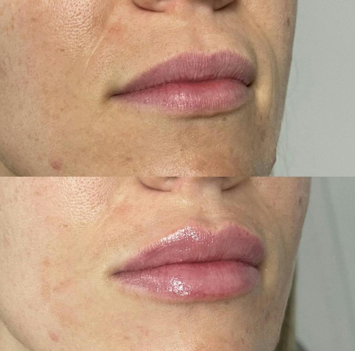 Lip Filler Before & After Gallery - Patient 187073937 - Image 3