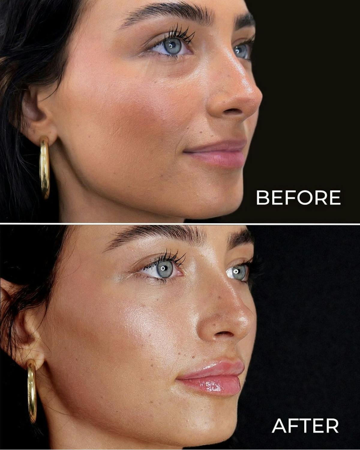 Lip Filler Before & After Gallery - Patient 187074330 - Image 1